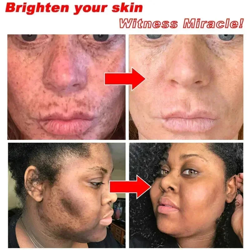 Dark Spots Removal Cream Facial Whitening Freckle Acne Mark Pigmentation Removal Melanin Skin Correction Brighten Care Products